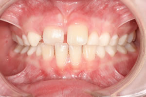 Cross-bite (Anterior)