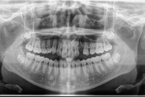 Ectopic teeth