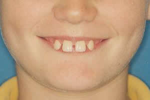 Protruding teeth